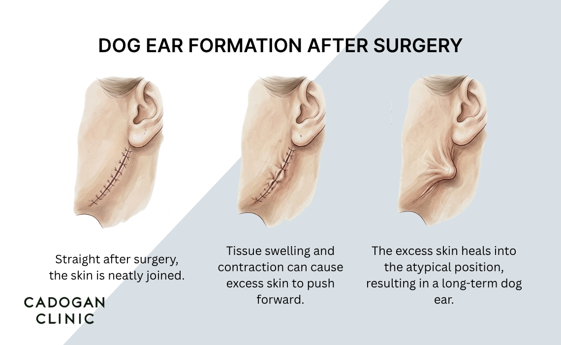 An infographic showing how dog ears form in a post-operative incision